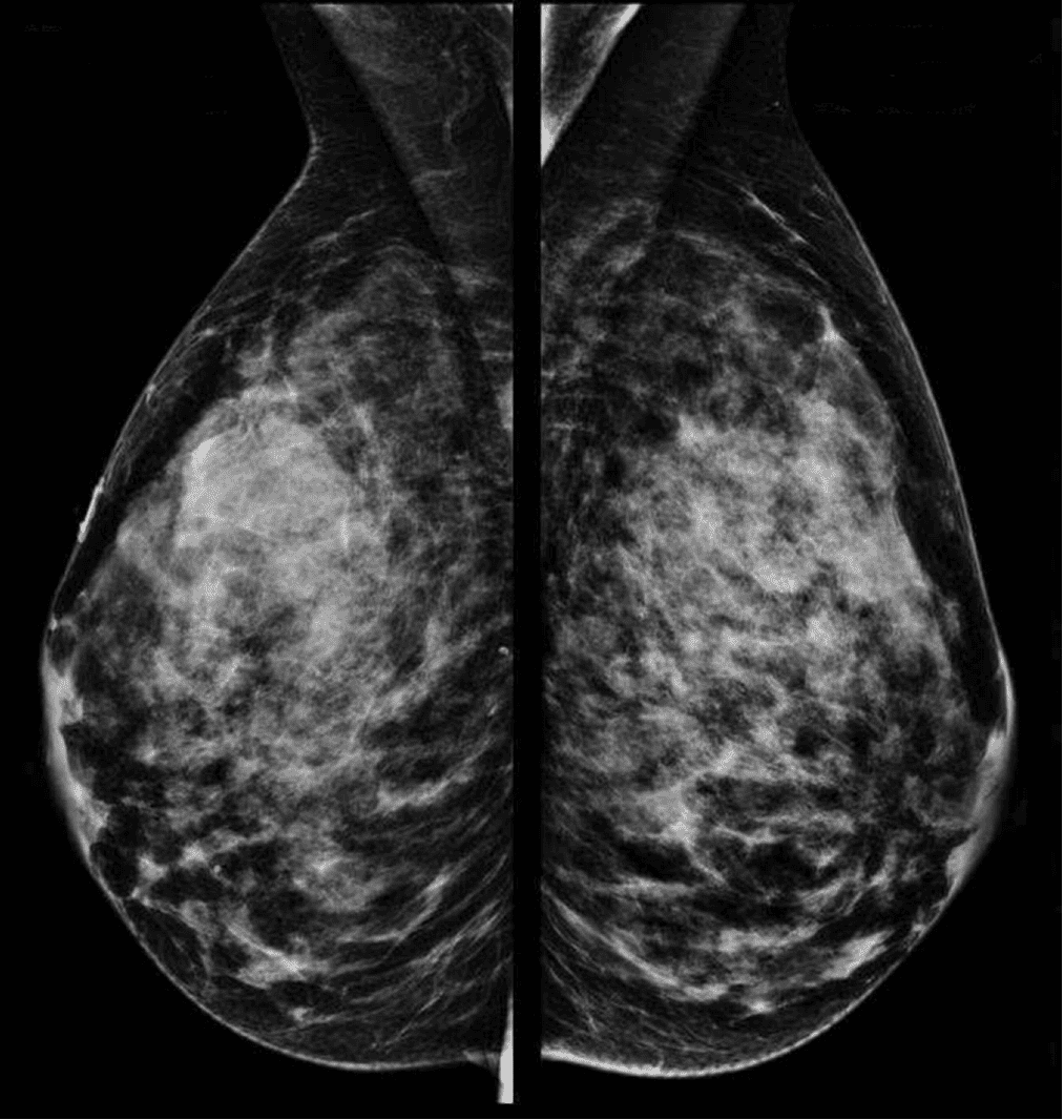 Traditional 2D X-Ray